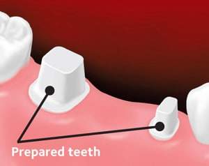 Fixed dental bridge 1