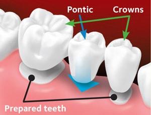 Let's talk about permanent, non-removable teeth replacement options –  Britten Perio