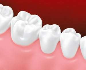 Let's talk about permanent, non-removable teeth replacement options –  Britten Perio